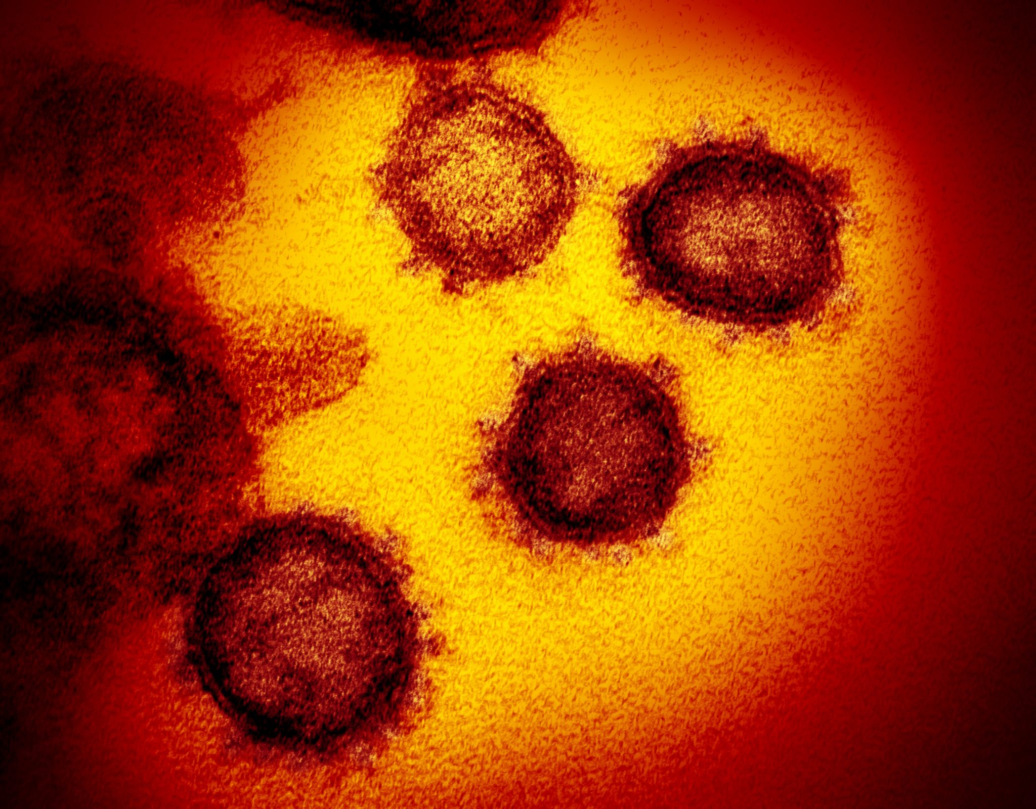 انواع علائم ویروس کرونا کووید 19 نشانه ها درمان و پیشگیری مراحل خفیف تا شدید بیماری روز به روز